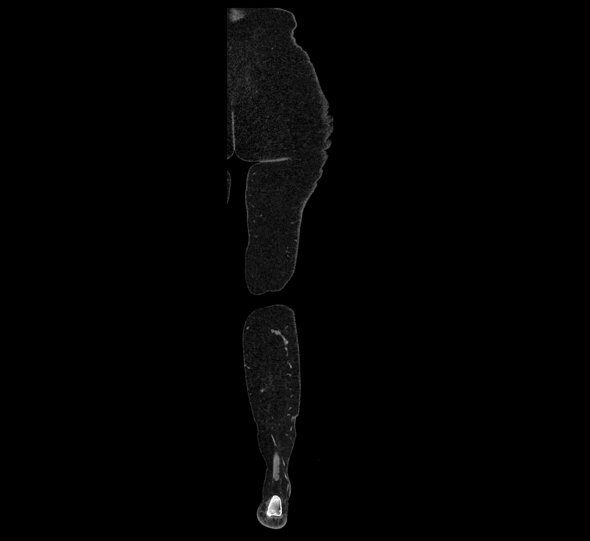 CTA lower limb coronal cross sectional anatomy labelled image _88 (2).webp